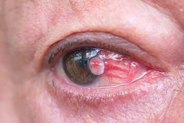 Close up of the conjunctival squamous cell carcinoma.