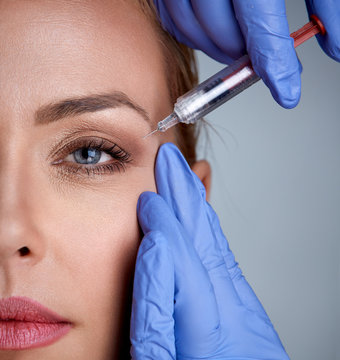 woman during surgery filling facial wrinkles
