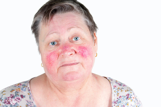 Rosacea, facial skin disorder, portrait of unhappy elderly woman