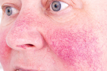 Rosacea, facial skin disorder, portrait of unhappy elderly woman