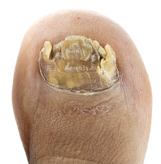 Close up image of right foot toe nail suffering from fungus infection isolated on white background © uwimages