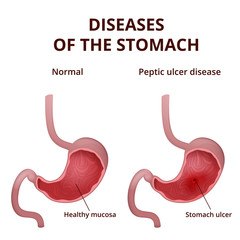 Obraz premium Anatomy of the human healthy and unhealthy stomach