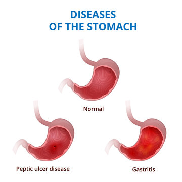 Anatomy of the human healthy and unhealthy stomach