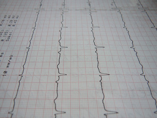Close up of ECG graph (electrocardiograph)