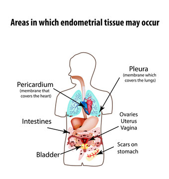 Areas in which endometrial tissue can appear. Endometriosis. Endometriosis in the body. The structure of the lungs, heart, intestine, stomach, liver, pelvic organs. Silhouette. Infographics Vector