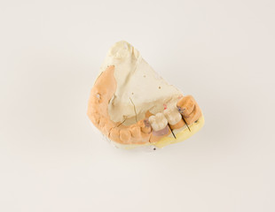 dental prosthesis manufacturing step