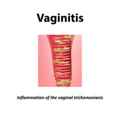 Inflammation of the vagina. Vaginitis. Vaginitis trichomoniasis. Infographics. Vector illustration on isolated background
