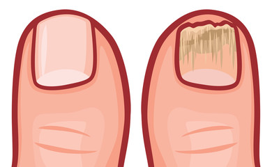 fungal infection of the nails vector illustration