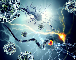 Damaged nerve cells, concept for neurodegenerative and neurological disease, tumors, brain surgery. - 123994316