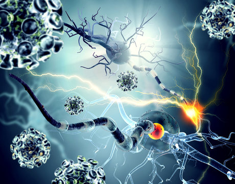 Damaged nerve cells, concept for neurodegenerative and neurological disease, tumors, brain surgery.