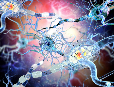 Damaged nerve cells, concept for neurodegenerative and neurological disease, tumors, brain surgery.