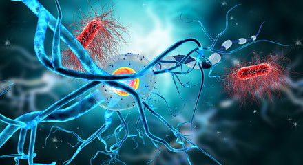 Damaged nerve cells, concept for neurodegenerative and neurological disease, tumors, brain surgery. - 123994558