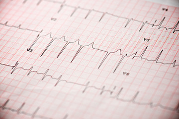 Electrocardiogram