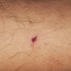 human skin with lesion