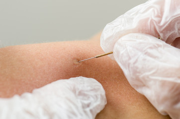 Closeup of a needle and hands of physiotherapist doing a dry needling.