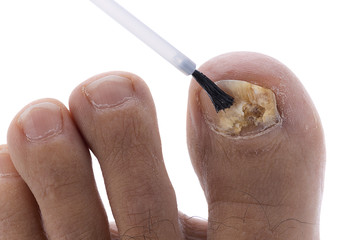 Applying Polish on Toenail Fungus Isolated © uwimages
