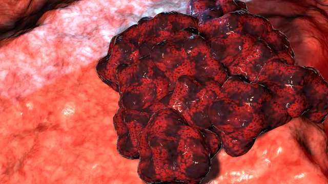 Cancer cell tumor, medical illustration. Neoplasm. Inflammation caused by an abnormal growth of tissue, whether benign or malignant.