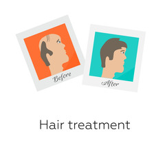 Vector illustration of two photographs of a man before and after hair treatment and hair transplantation. Male hair loss design template. Alopecia medical concept.
