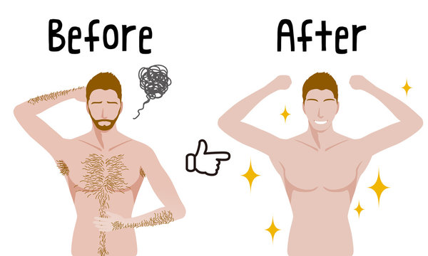 men's hair removal before after concept, unwanted hair, superfluous hair, vector illustration