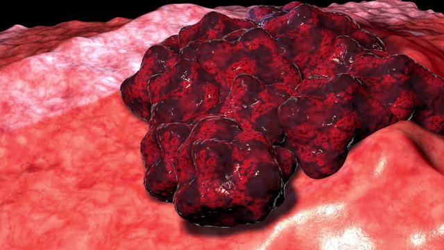     Cancer cell tumor, medical illustration. Neoplasm. Inflammation caused by an abnormal growth of tissue, whether benign or malignant. 