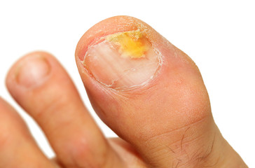 Onychomycosis fungal infection of the nail.  It is the most common disease of the nails. It is an...