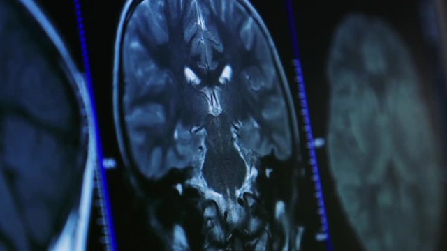 X-Ray Image on Monitor Display