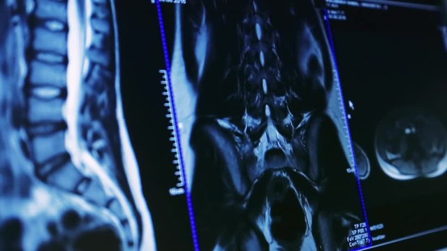 X-Ray Image on Monitor Display