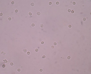 white blood cells. in Urinary Tract Infections find with microsc