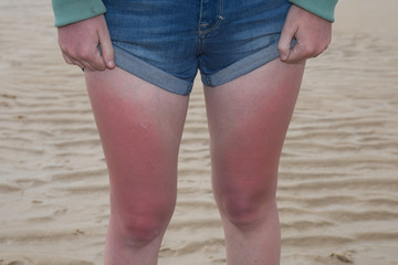 Sunburn. woman with massive sunburn on her legs