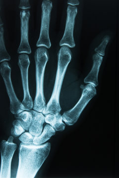 R&ouml;ntgenaufnahme Hand rechts