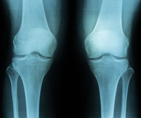 Röntgenaufnahme Beine Stehend