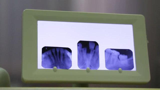 Dental x-ray examination of the teeth