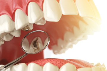 Human tooth with caries, hole and tools. Dental searching concep