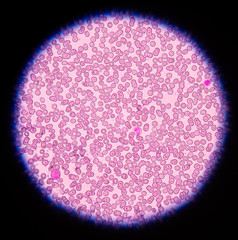  blood smear is often used as a follow-up test to abnormal resul