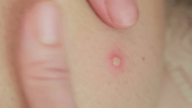 macro texture of burns on human skin back. wound treatment