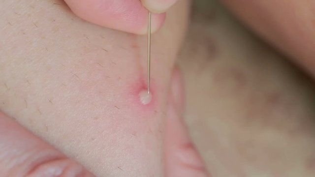 macro texture of burns on human skin back. wound treatment