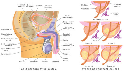 Male Genitourinary System. Anatomy of the male reproductive system. Stages of prostate cancer on a white background