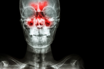 Sinusitis. film x-ray skull AP ( anterior - posterior ) show infection and inflammation at frontal sinus , ethmoid sinus , maxillary sinus and blank area at right side © stockdevil