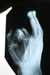 x-ray hands 	 Roentgen
