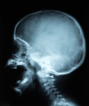 Schädel Röntgen Bild mit Hals Wirbelsäule seitlich vom Kind