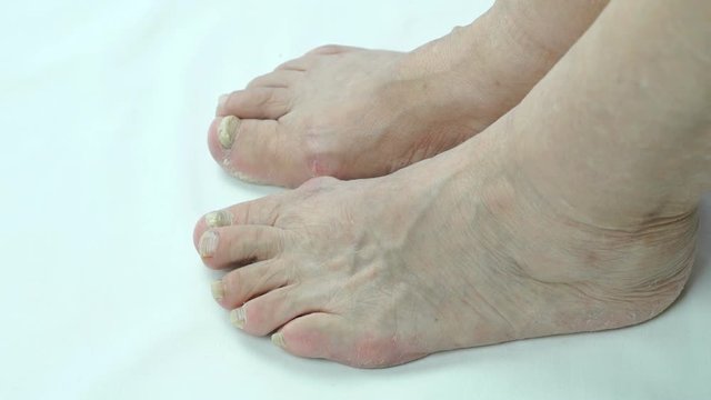 Onychomycosis with fungal nail infection