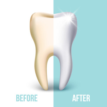 Dental veneer, teeth whitening vector concept