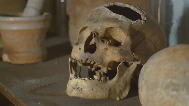 Skull Found During the Excavation of a Medical Hole in the Frontal Bone. Operation on the Human Skull in Ancient Times