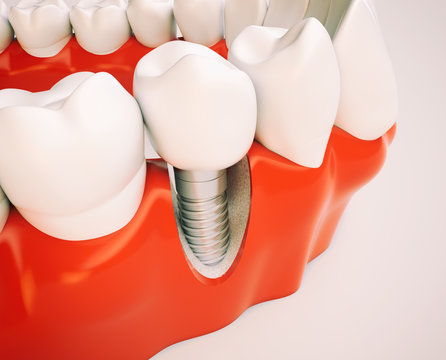 Dental implant - 3d rendering