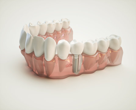 Dental implant - 3d rendering