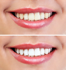 Demonstration of dental whitening result, before and after procedure. Dentistry concept.