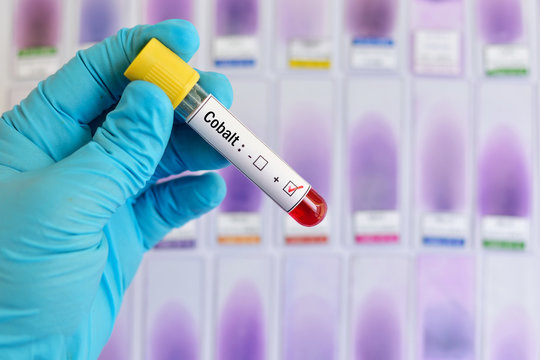 Blood sample positive with cobalt (Co) test
