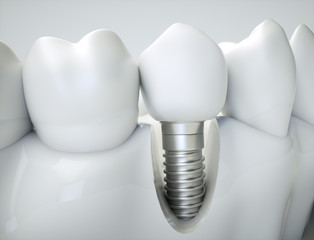 Dental implant - 3d rendering - obrazy, fototapety, plakaty