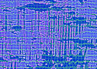 Brain wave on electroencephalogram EEG for epilepsy