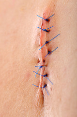 Suture Close up